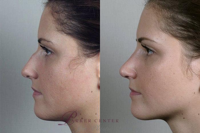 Rhinoplasty Case 201 Before & After View #2 | Paramus, New Jersey | Parker Center for Plastic Surgery