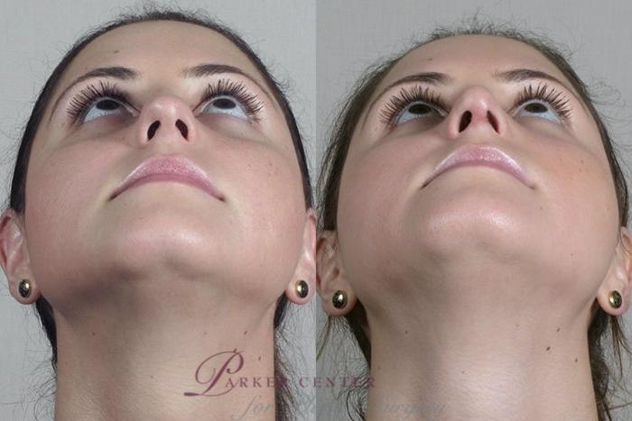 Rhinoplasty Case 201 Before & After View #3 | Paramus, New Jersey | Parker Center for Plastic Surgery
