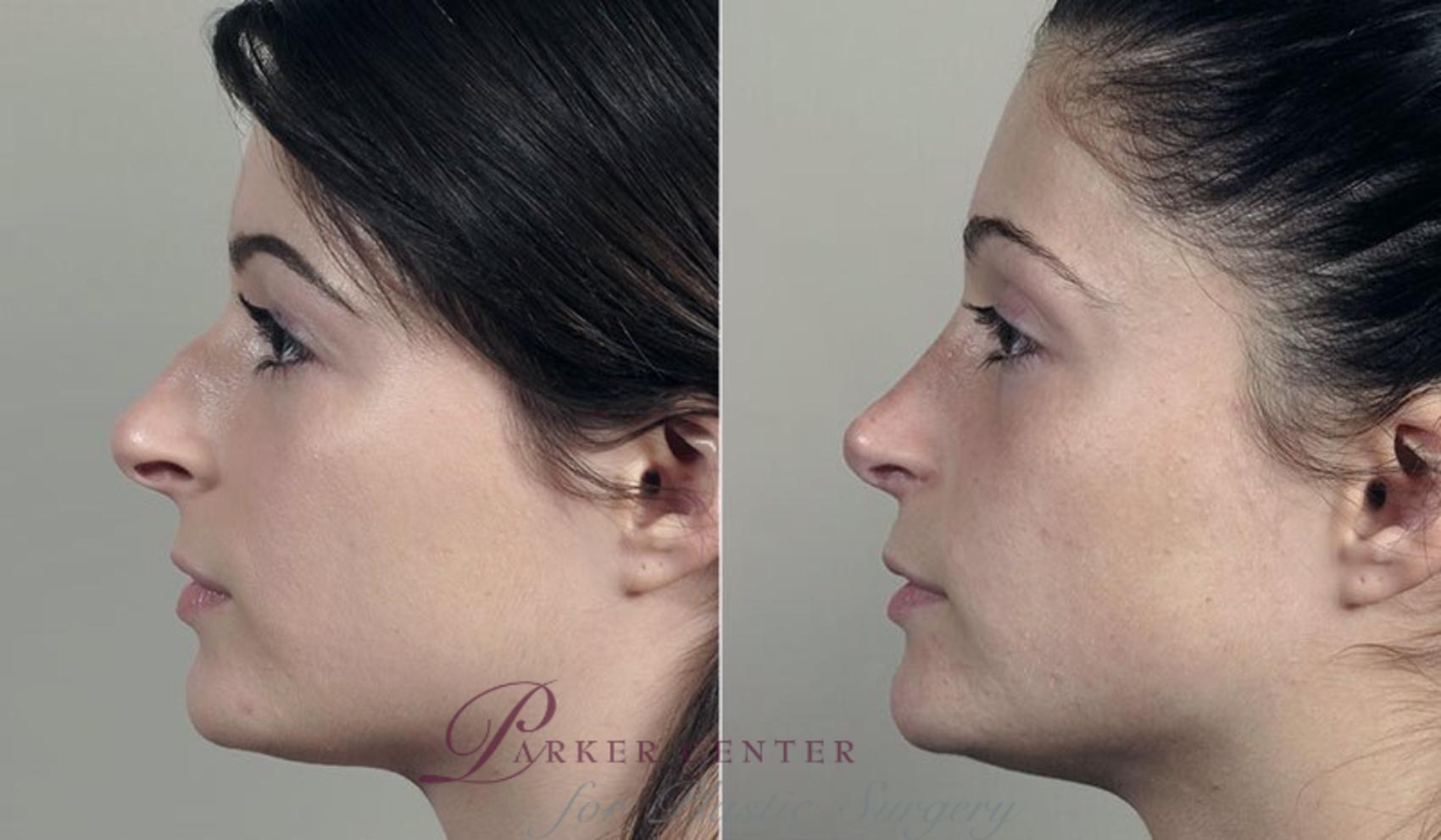 Rhinoplasty Case 202 Before & After View #2 | Paramus, New Jersey | Parker Center for Plastic Surgery