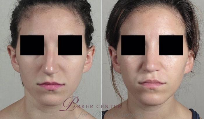 Rhinoplasty Case 203 Before & After View #1 | Paramus, NJ | Parker Center for Plastic Surgery