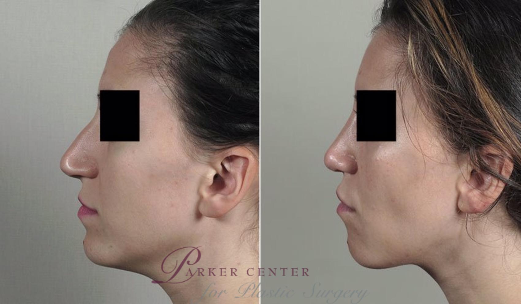 Rhinoplasty Case 203 Before & After View #2 | Paramus, NJ | Parker Center for Plastic Surgery