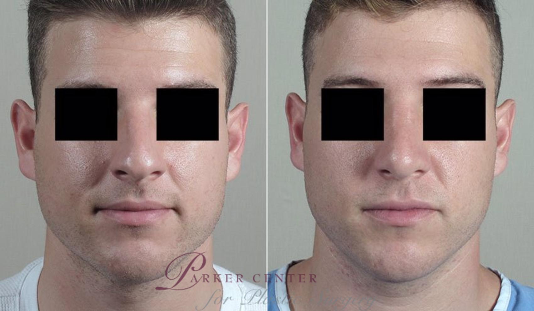 Rhinoplasty Case 204 Before & After View #1 | Paramus, NJ | Parker Center for Plastic Surgery