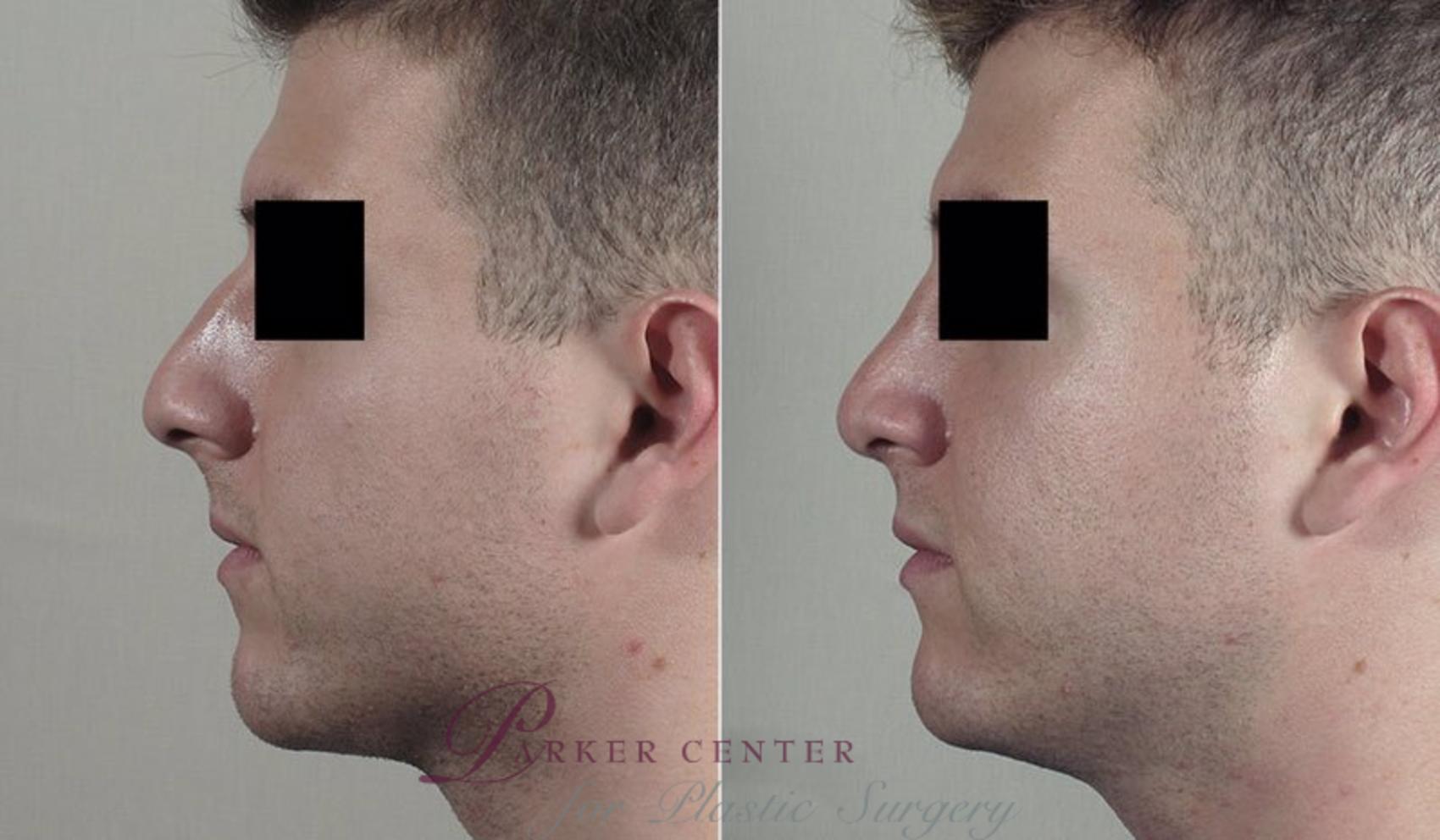 Rhinoplasty Case 204 Before & After View #2 | Paramus, NJ | Parker Center for Plastic Surgery