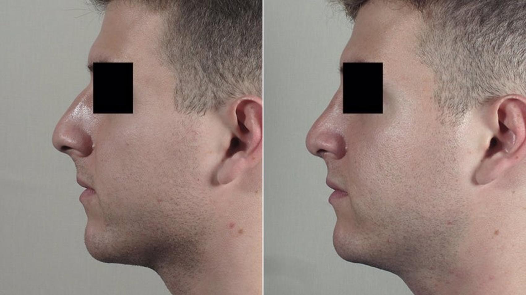 Rhinoplasty Case 204 Before & After View #2 | Paramus, NJ | Parker Center for Plastic Surgery