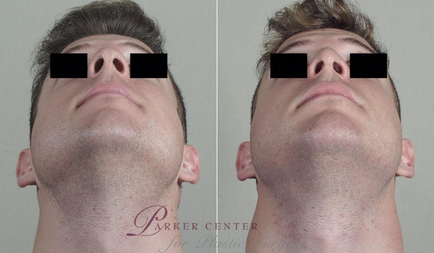 Rhinoplasty Case 204 Before & After View #3 | Paramus, NJ | Parker Center for Plastic Surgery