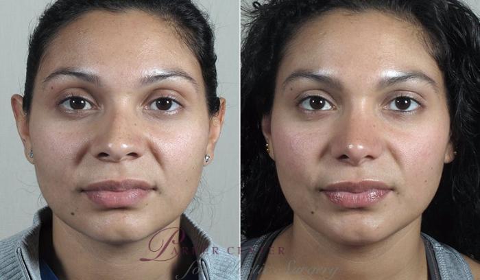 Rhinoplasty Case 205 Before & After View #1 | Paramus, NJ | Parker Center for Plastic Surgery