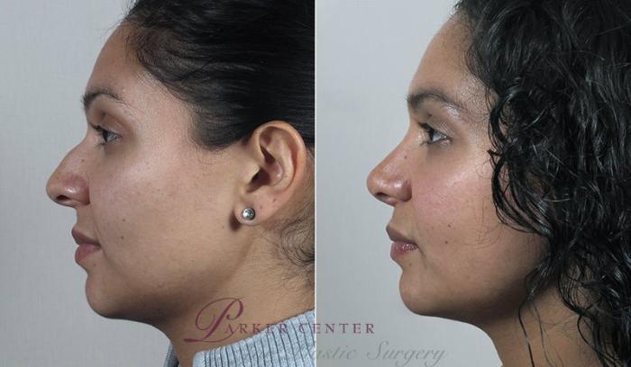 Rhinoplasty Case 205 Before & After View #2 | Paramus, NJ | Parker Center for Plastic Surgery