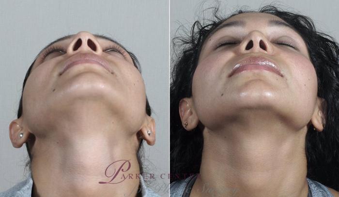 Rhinoplasty Case 205 Before & After View #3 | Paramus, NJ | Parker Center for Plastic Surgery