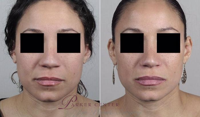 Rhinoplasty Case 206 Before & After View #1 | Paramus, NJ | Parker Center for Plastic Surgery