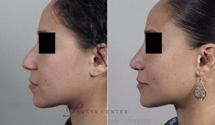 Rhinoplasty Case 206 Before & After View #2 | Paramus, NJ | Parker Center for Plastic Surgery