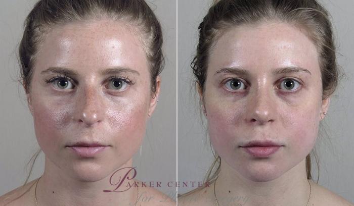 Rhinoplasty Case 207 Before & After View #1 | Paramus, NJ | Parker Center for Plastic Surgery