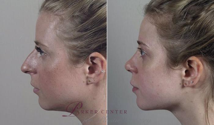 Rhinoplasty Case 207 Before & After View #2 | Paramus, NJ | Parker Center for Plastic Surgery