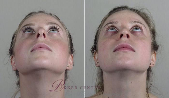 Rhinoplasty Case 207 Before & After View #3 | Paramus, NJ | Parker Center for Plastic Surgery