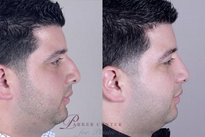 Rhinoplasty Case 951 Before & After View #5 | Paramus, New Jersey | Parker Center for Plastic Surgery