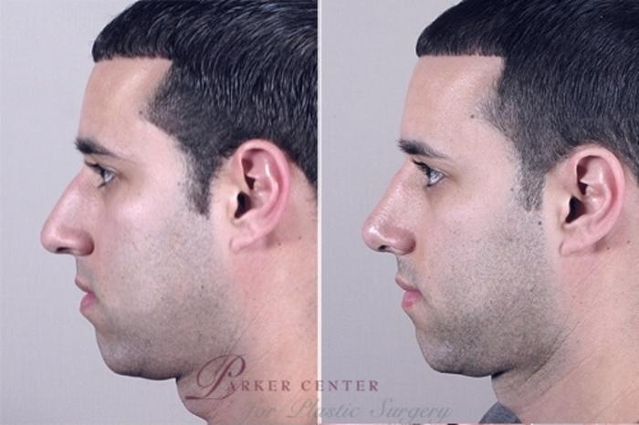 Rhinoplasty Case 952 Before & After View #5 | Paramus, New Jersey | Parker Center for Plastic Surgery