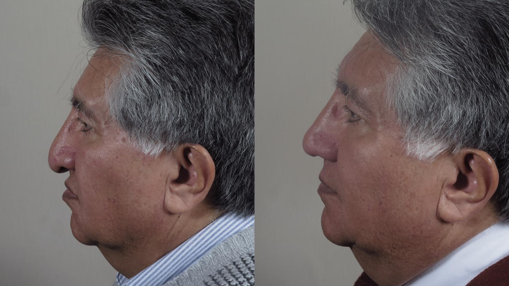 Rhinoplasty Case 967 Before & After Right Side | Paramus, NJ | Parker Center for Plastic Surgery