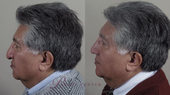 Rhinoplasty Case 967 Before & After Right Side | Paramus, New Jersey | Parker Center for Plastic Surgery