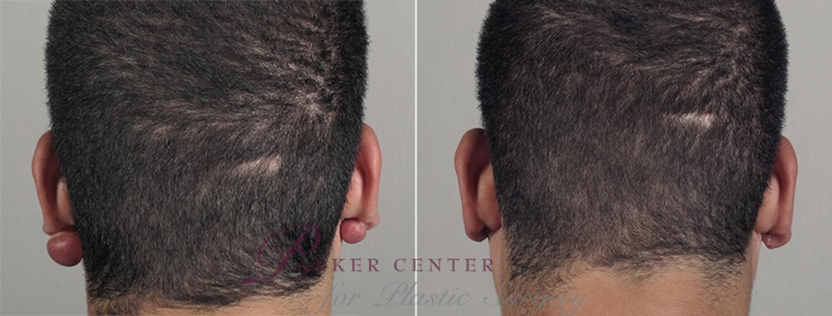 Skin Cancer Treatment Case 1036 Before & After View #2 | Paramus, NJ | Parker Center for Plastic Surgery