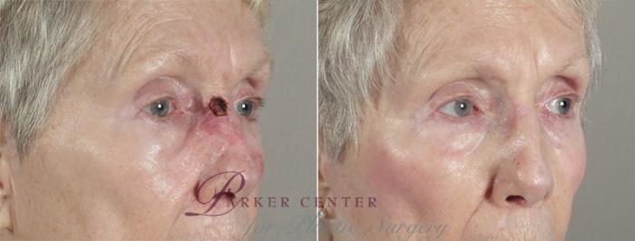 Skin Cancer Treatment Case 1037 Before & After View #2 | Paramus, NJ | Parker Center for Plastic Surgery
