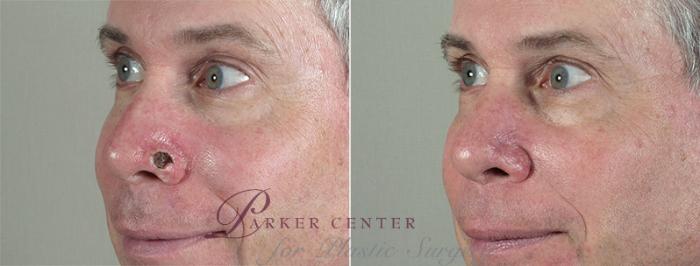 Skin Cancer Treatment Case 1039 Before & After View #1 | Paramus, NJ | Parker Center for Plastic Surgery