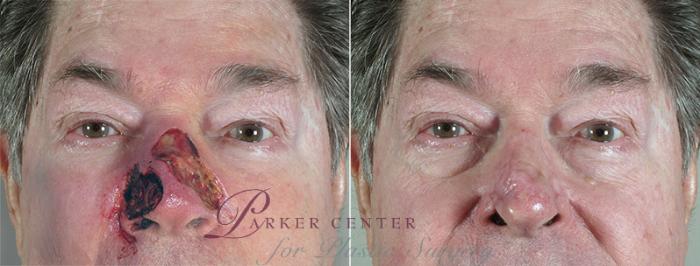 Skin Cancer Treatment Case 1040 Before & After View #1 | Paramus, NJ | Parker Center for Plastic Surgery