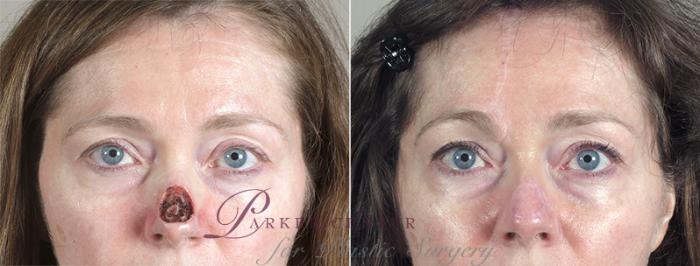 Skin Cancer Treatment Case 1041 Before & After View #1 | Paramus, NJ | Parker Center for Plastic Surgery
