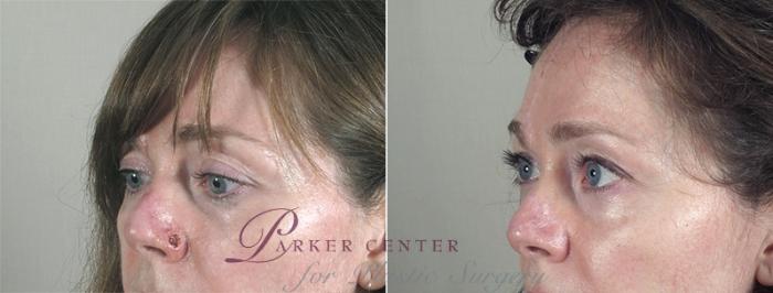 Skin Cancer Treatment Case 1041 Before & After View #3 | Paramus, NJ | Parker Center for Plastic Surgery