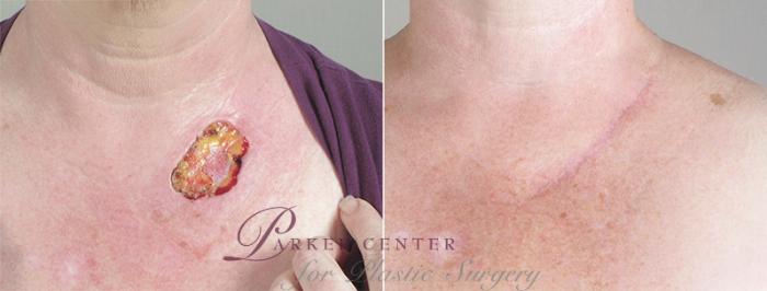 Skin Cancer Treatment Case 1042 Before & After View #1 | Paramus, NJ | Parker Center for Plastic Surgery