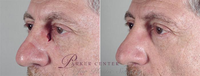 Skin Cancer Treatment Case 1044 Before & After View #1 | Paramus, NJ | Parker Center for Plastic Surgery
