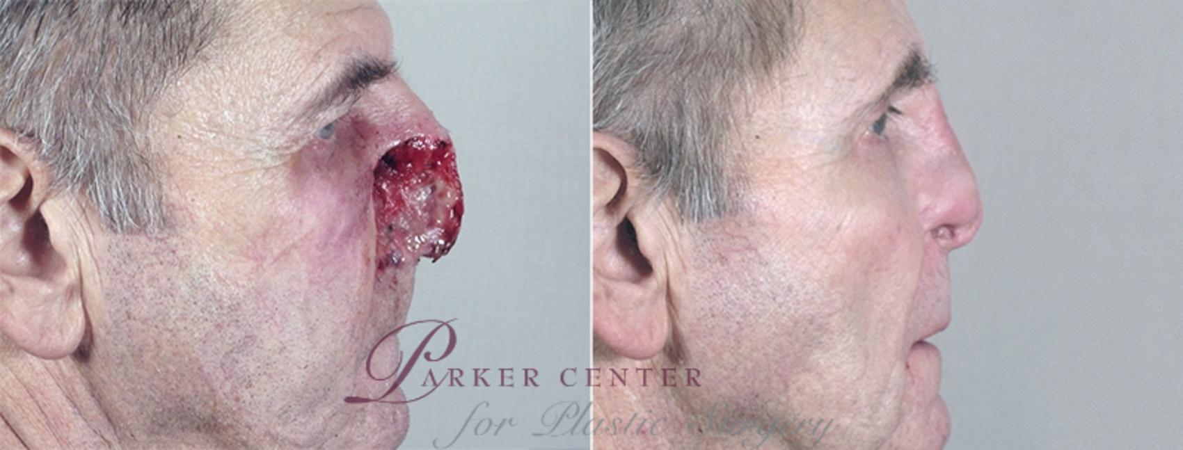 Skin Cancer Treatment Case 1045 Before & After View #2 | Paramus, NJ | Parker Center for Plastic Surgery
