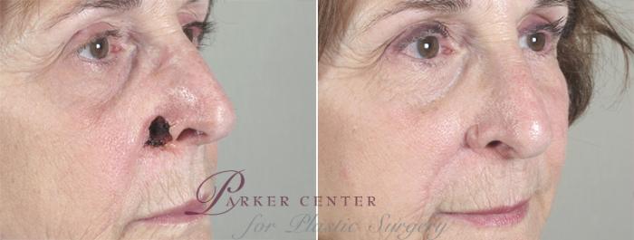 Skin Cancer Treatment Case 1046 Before & After View #1 | Paramus, NJ | Parker Center for Plastic Surgery