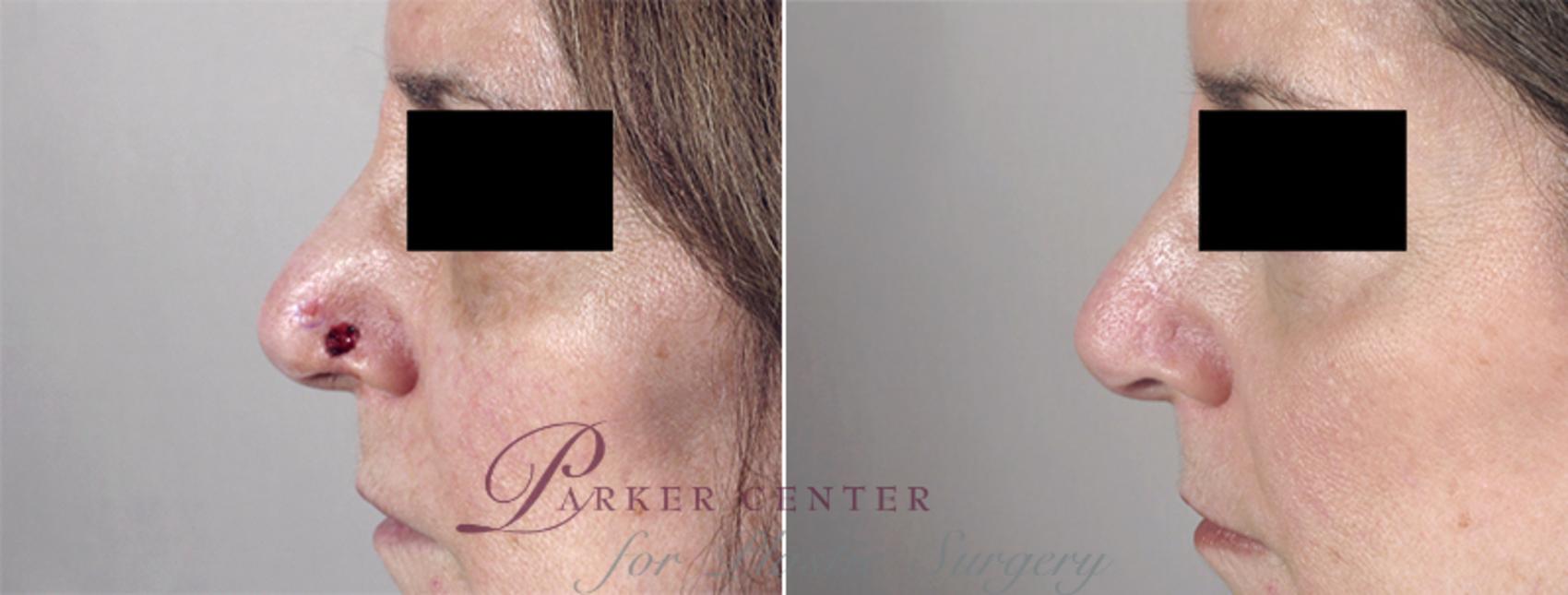 Skin Cancer Treatment Case 1047 Before & After View #1 | Paramus, NJ | Parker Center for Plastic Surgery