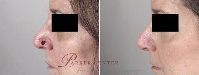 Skin Cancer Treatment Case 1047 Before & After View #1 | Paramus, NJ | Parker Center for Plastic Surgery