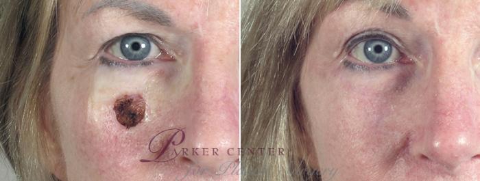 Skin Cancer Treatment Case 1048 Before & After View #1 | Paramus, NJ | Parker Center for Plastic Surgery