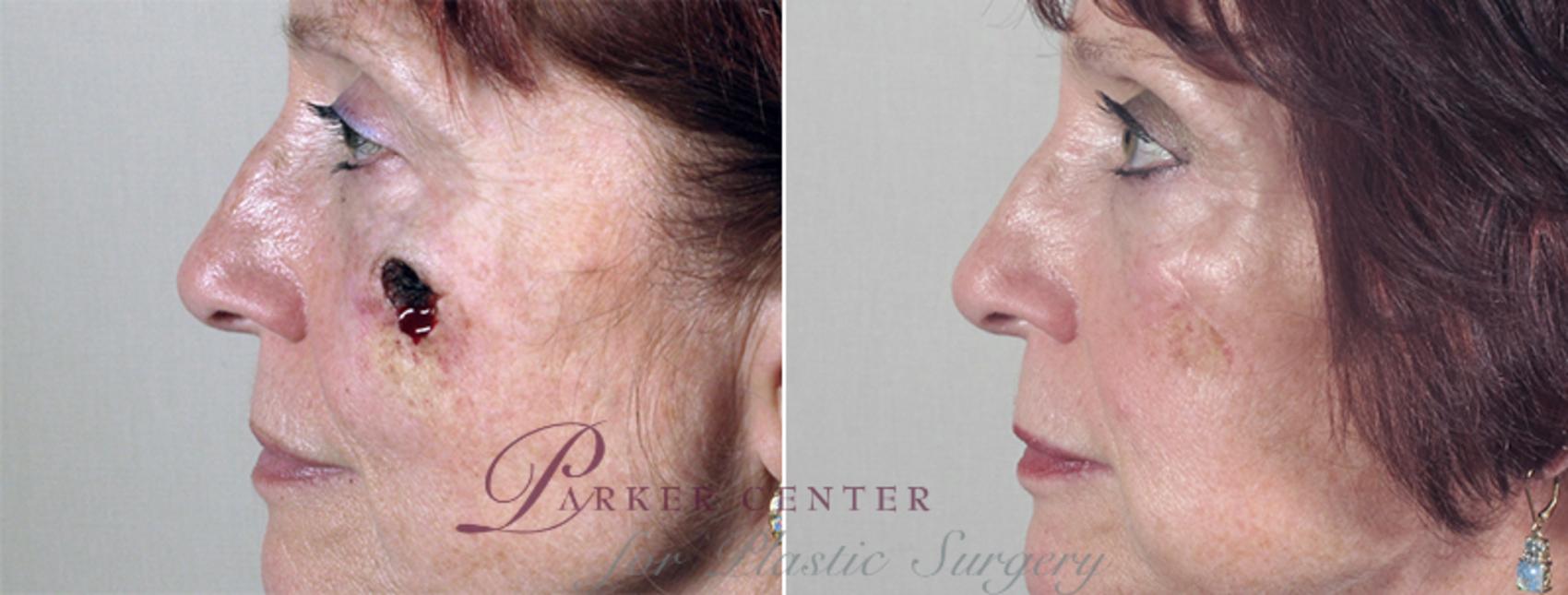 Skin Cancer Treatment Case 1049 Before & After View #1 | Paramus, NJ | Parker Center for Plastic Surgery
