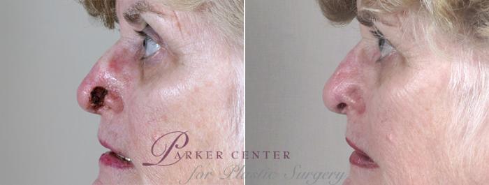 Skin Cancer Treatment Case 1050 Before & After View #1 | Paramus, NJ | Parker Center for Plastic Surgery