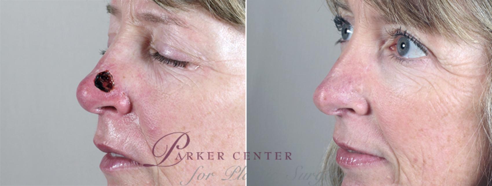 Skin Cancer Treatment Case 1051 Before & After View #1 | Paramus, NJ | Parker Center for Plastic Surgery