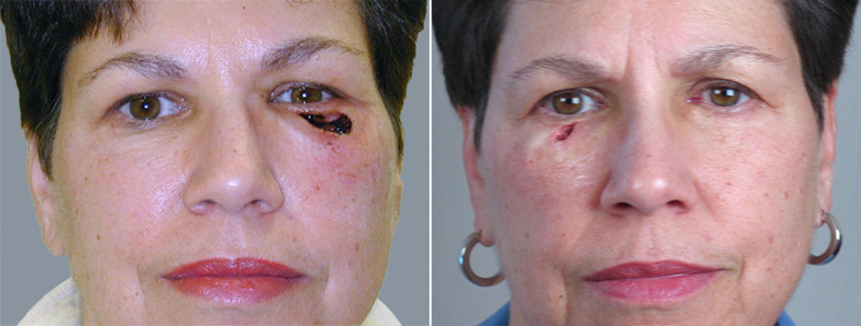 Skin Cancer Treatment Before And After Pictures Case 1053 Paramus Nj Parker Center For 