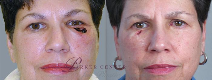 Skin Cancer Treatment Case 1053 Before & After View #1 | Paramus, NJ | Parker Center for Plastic Surgery