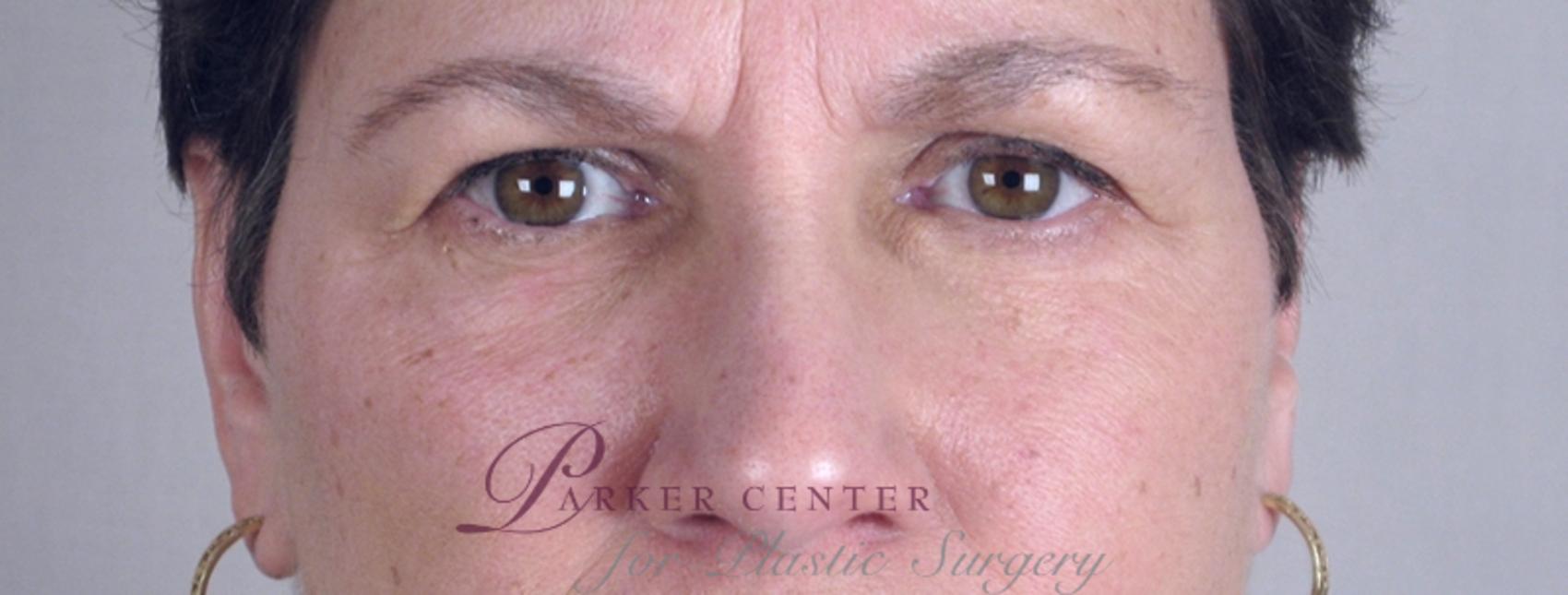 Skin Cancer Treatment Case 1053 Before & After View #2 | Paramus, NJ | Parker Center for Plastic Surgery