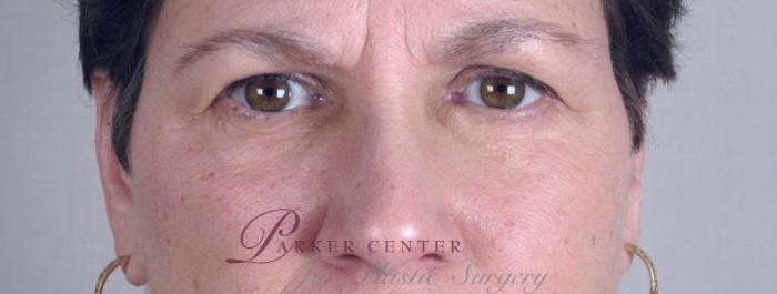 Skin Cancer Treatment Case 1053 Before & After View #2 | Paramus, NJ | Parker Center for Plastic Surgery