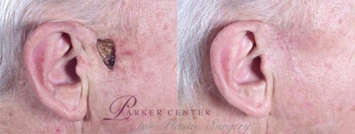 Skin Cancer Treatment Case 1058 Before & After View #1 | Paramus, NJ | Parker Center for Plastic Surgery