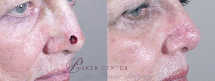 Skin Cancer Treatment Case 1059 Before & After View #1 | Paramus, NJ | Parker Center for Plastic Surgery