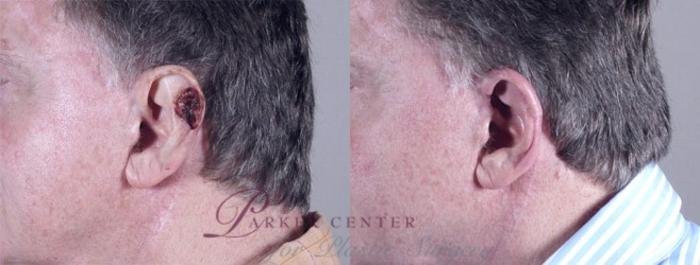 Skin Cancer Treatment Case 1060 Before & After View #1 | Paramus, NJ | Parker Center for Plastic Surgery