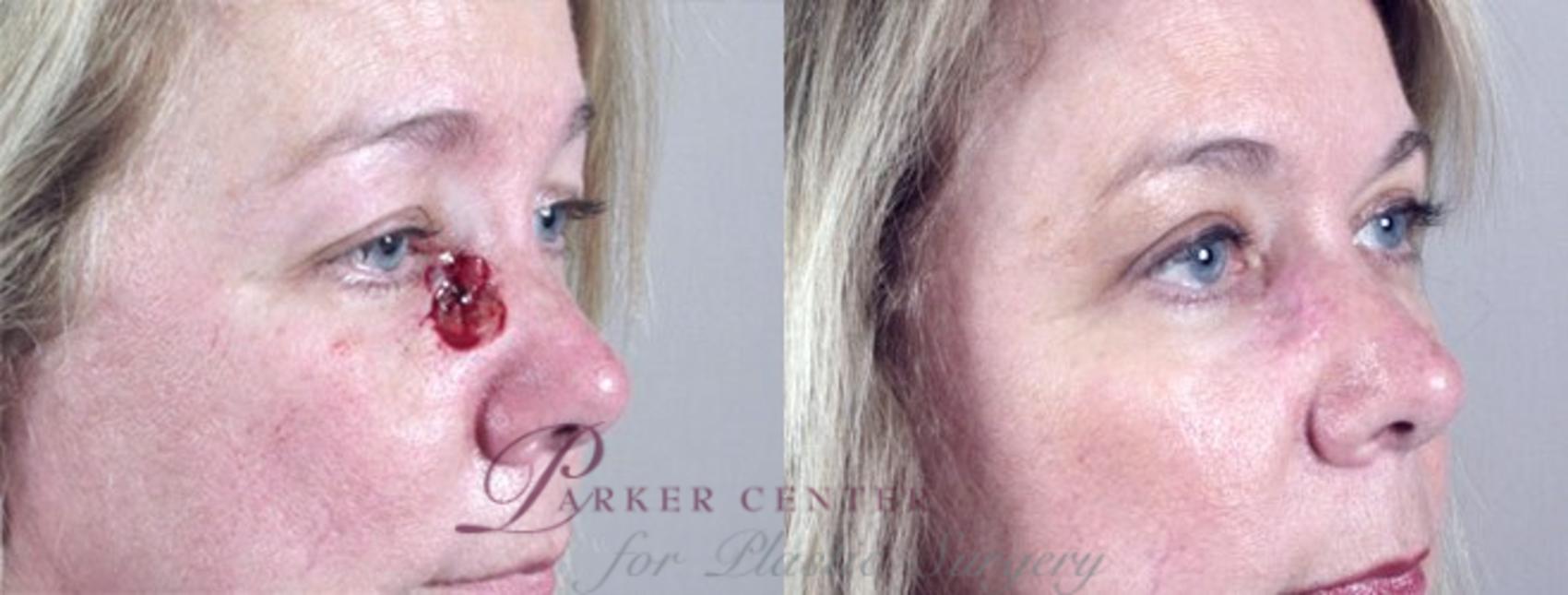Skin Cancer Treatment Case 1062 Before & After View #1 | Paramus, NJ | Parker Center for Plastic Surgery