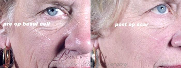 Skin Cancer Treatment Case 1064 Before & After View #1 | Paramus, NJ | Parker Center for Plastic Surgery