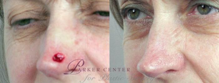 Skin Cancer Treatment Case 1065 Before & After View #1 | Paramus, NJ | Parker Center for Plastic Surgery