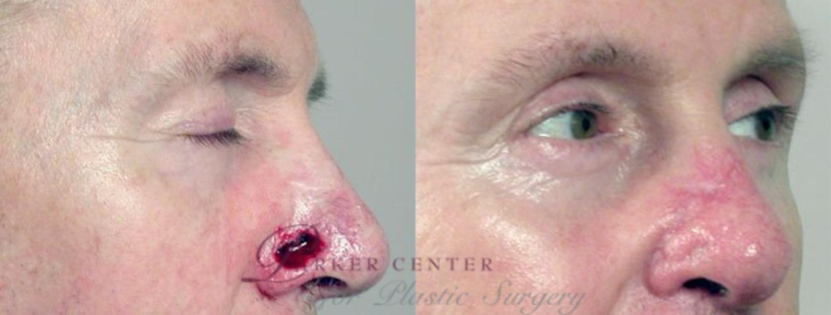 Skin Cancer Treatment Case 1066 Before & After View #1 | Paramus, NJ | Parker Center for Plastic Surgery