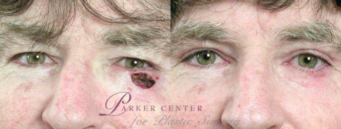 Skin Cancer Treatment Case 1067 Before & After View #1 | Paramus, NJ | Parker Center for Plastic Surgery