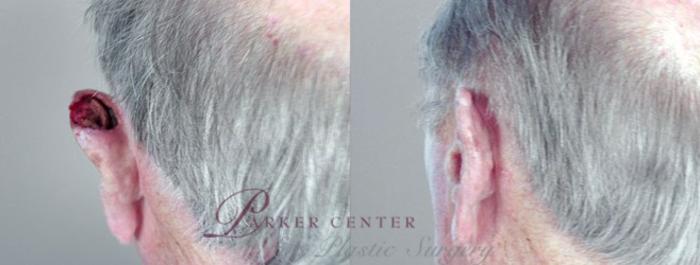 Skin Cancer Treatment Case 1069 Before & After View #1 | Paramus, NJ | Parker Center for Plastic Surgery